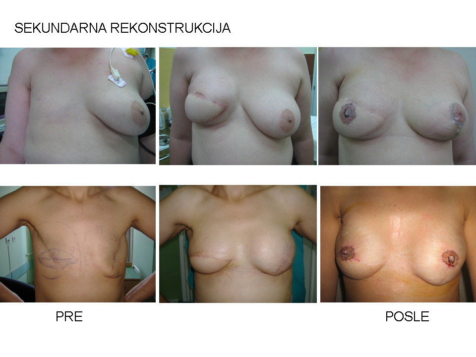 Sekundarna rekonstrukcija